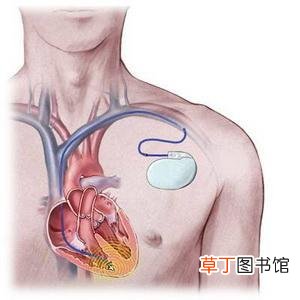 窦性心律不齐是什么意思?窦性心律对人体的影响