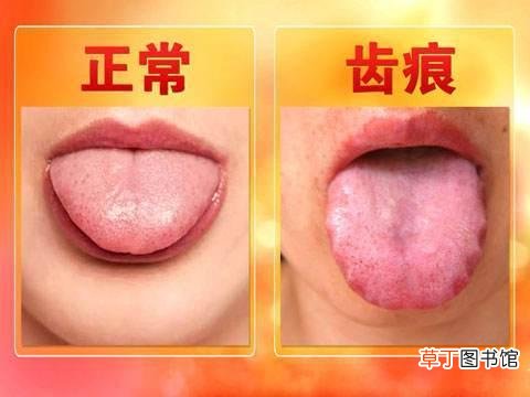 舌苔白有齿痕怎么调理-调理舌苔白有齿痕的方法