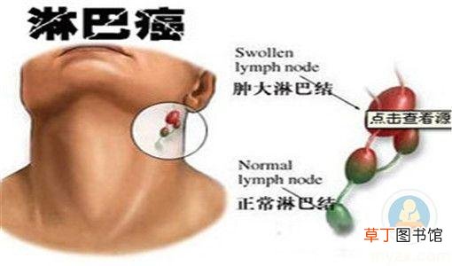 淋巴癌早期症状有哪些-淋巴癌有哪些早期症状