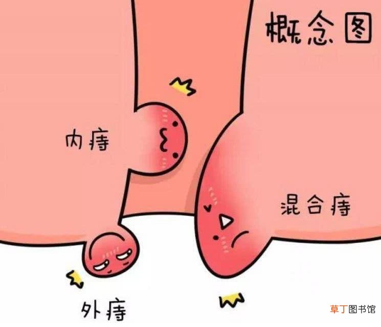 治疗痔疮的偏方-有哪些治疗痔疮的偏方