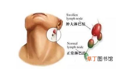 淋巴结发炎吃什么药见效最快-淋巴结发炎吃什么药比较好