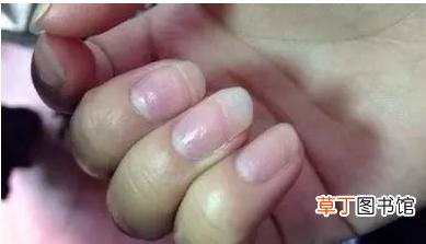 指甲有凹陷-指甲有凹陷是什么原因