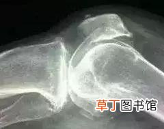 骨刺的最佳治疗方法是什么？
