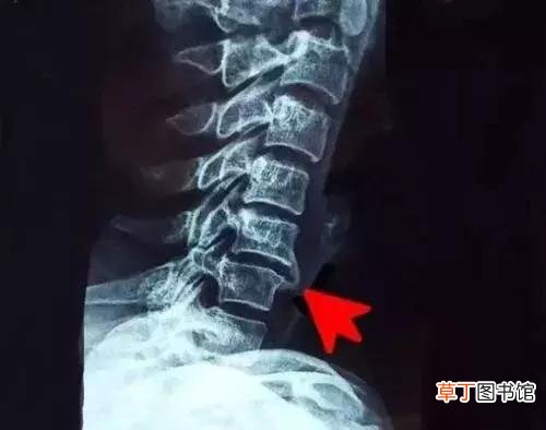 骨刺的最佳治疗方法是什么？