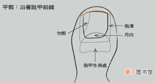 甲沟炎自己怎么处理-甲沟炎自己可以处理吗