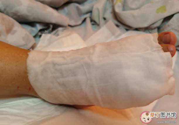 夏季被毒虫咬伤怎么处理急救 被毒虫咬伤有什么表现症状