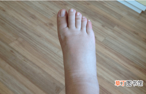 脚浮肿怎么消肿小方法-脚浮肿怎么消肿
