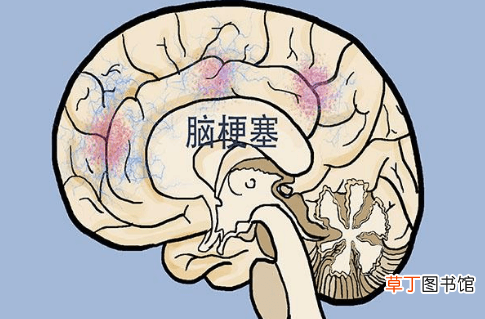 促进脑梗病人康复的中成药有哪些-促进脑梗病人康复的中成药成分