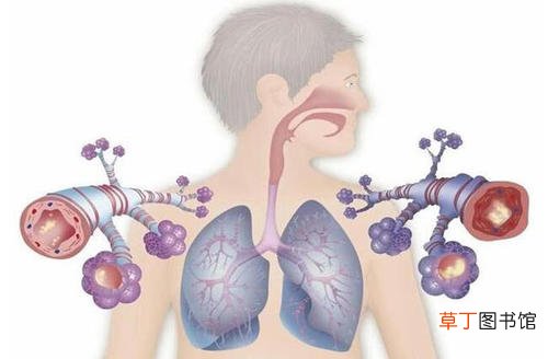 治支气管炎的妙招-治支气管炎的简单方法