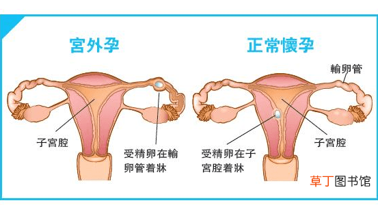 宫外孕怎么办处理方法-宫外孕处理方法介绍说明
