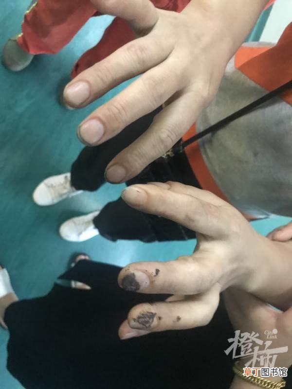 烧伤女孩病危 电动自行车行业商会下发紧急通知 电瓶车行驶中爆燃