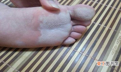 脚气病又痒又尴尬 秋季是治脚气最佳期