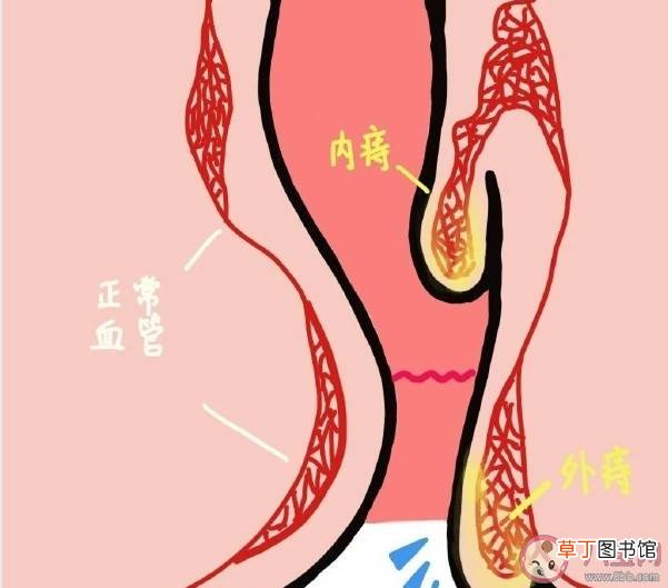 痔疮什么时候必须手术 痔疮疼痛出血怎么办