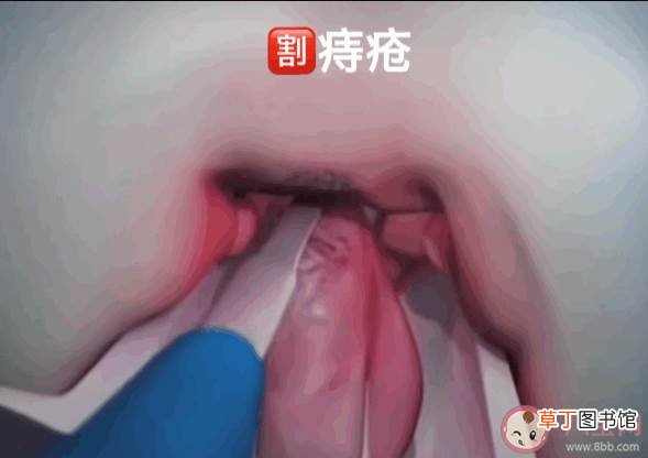 痔疮什么时候必须手术 痔疮疼痛出血怎么办