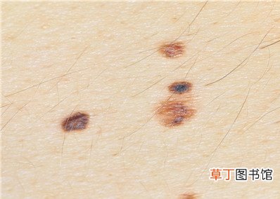什么样的黑痣容易癌变-哪些黑痣容易癌变-黑痣癌变的预防方法