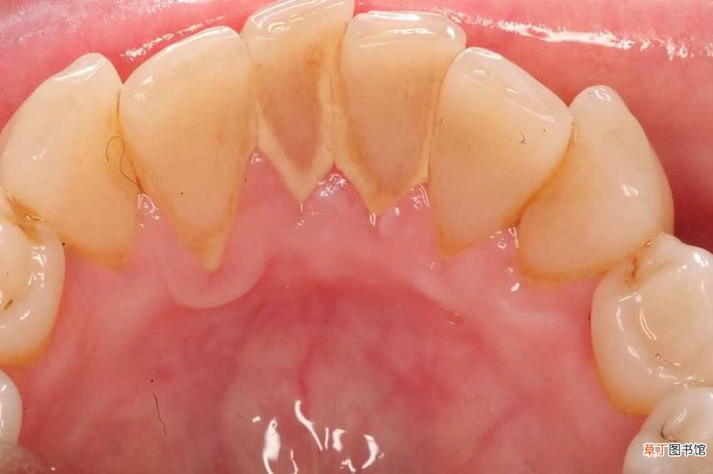 矫正牙齿要拔牙4颗有危害吗 多久洗一次牙比较好