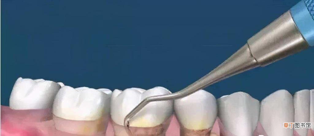 矫正牙齿要拔牙4颗有危害吗 多久洗一次牙比较好