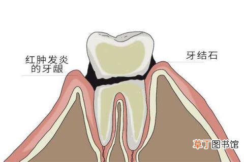 洗牙应该隔多久去一次 洗牙多久一次
