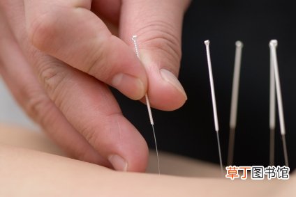 针灸治疗治标又治本 这些禁忌你都知道吗