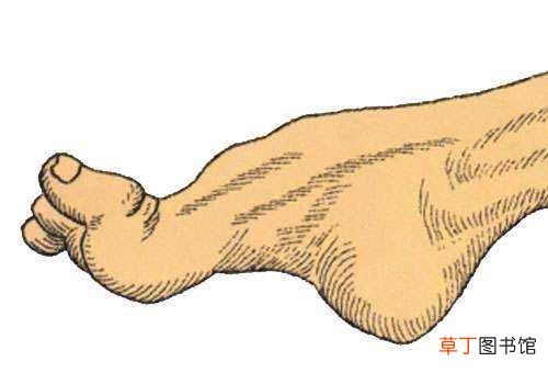 脚上出现这几个症状，警惕糖尿病足