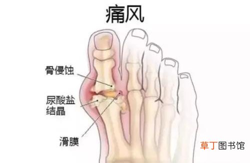 这几种食物多吃专防高尿酸，让你远离痛风