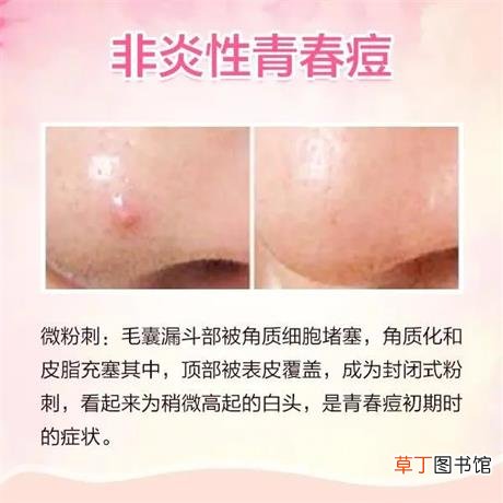 痘痘种类及图片高清-脸上六种痘痘类型及图片大全