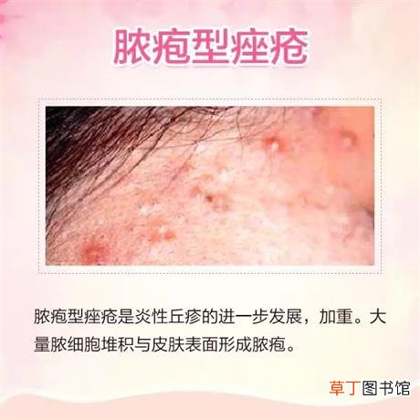 痘痘种类及图片高清-脸上六种痘痘类型及图片大全