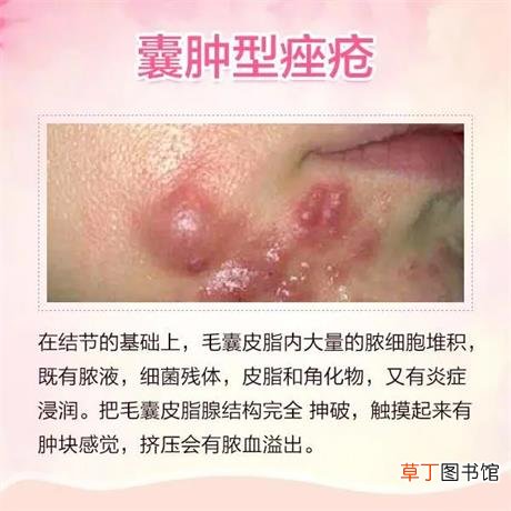 痘痘种类及图片高清-脸上六种痘痘类型及图片大全