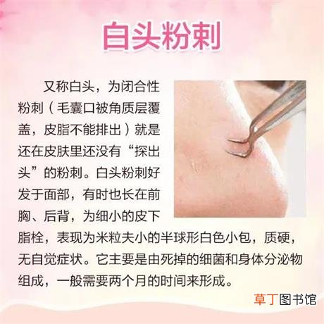 痘痘种类及图片高清-脸上六种痘痘类型及图片大全