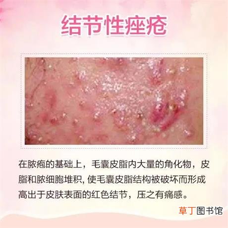 痘痘种类及图片高清-脸上六种痘痘类型及图片大全
