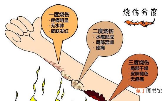 芦荟可以治烫伤吗-芦荟可以修复烫伤的皮肤吗