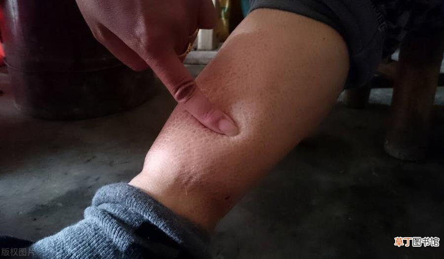 尿毒症泡沫尿多久消失 泡沫尿多久