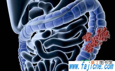 大肠癌的早期症状发现几个月能死 超9成大肠癌源于息肉癌变真的假的