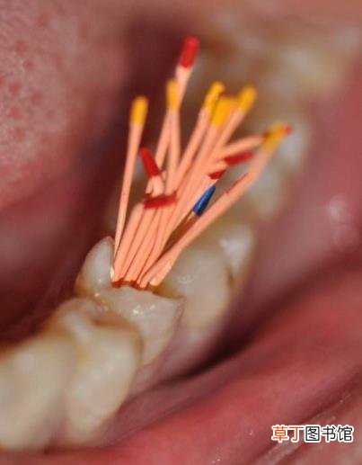 杀牙神经哪个步骤最痛 杀牙神经要多久