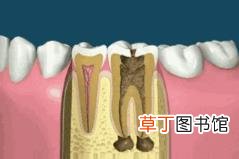 杀牙神经哪个步骤最痛 杀牙神经要多久