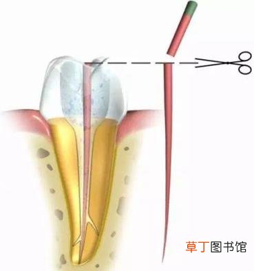 杀牙神经哪个步骤最痛 杀牙神经要多久