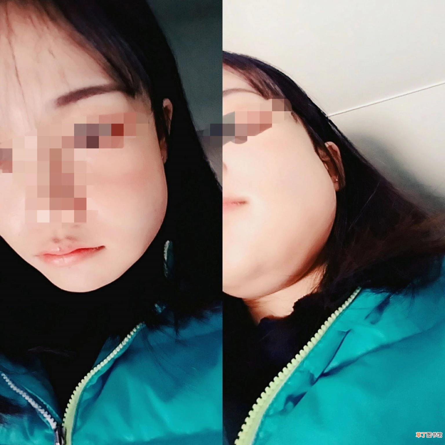 拔完智齿后可不可以一直冰敷 拔牙冰敷多久