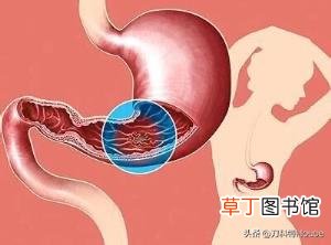 早期胃癌esd术后复查时间 胃癌术后多久复查一次