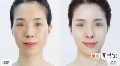 脂肪填充20天脸大了一圈 脂肪填充多久自然