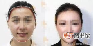 脂肪填充20天脸大了一圈 脂肪填充多久自然
