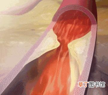 支架后不吃药有8年了 心脏支架能活多久