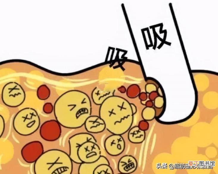 抽脂多久才能看出瘦身的效果 吸脂要多久恢复