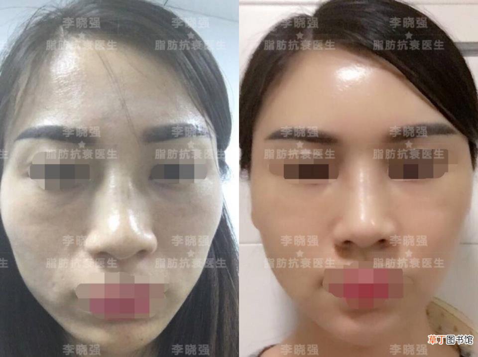 面部溶脂针能维持多久 面部填充能维持多久