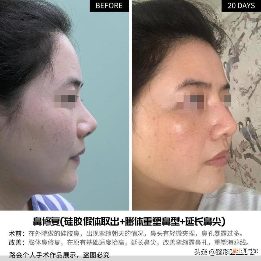 隆鼻拆线鼻子好宽好肿 隆鼻后多久拆线