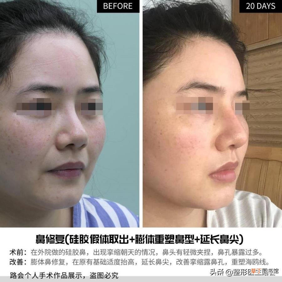 隆鼻拆线鼻子好宽好肿 隆鼻后多久拆线