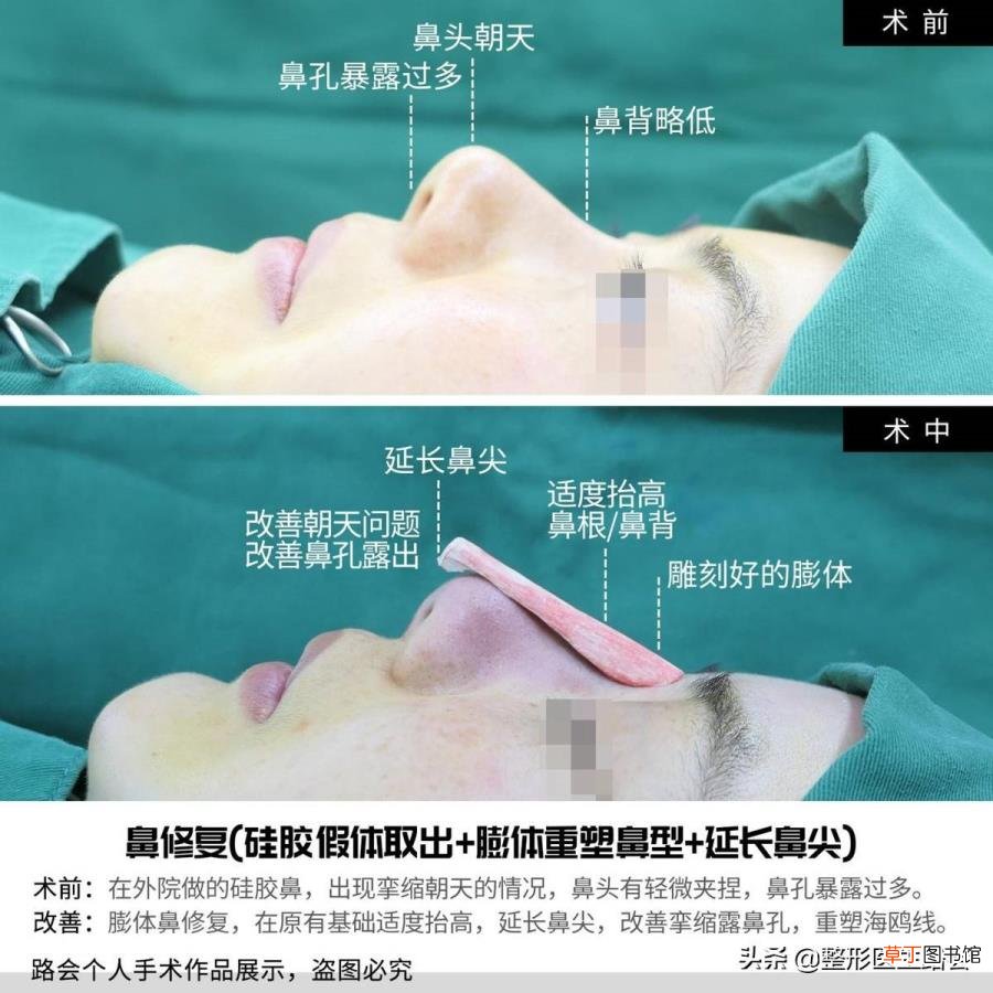 隆鼻拆线鼻子好宽好肿 隆鼻后多久拆线