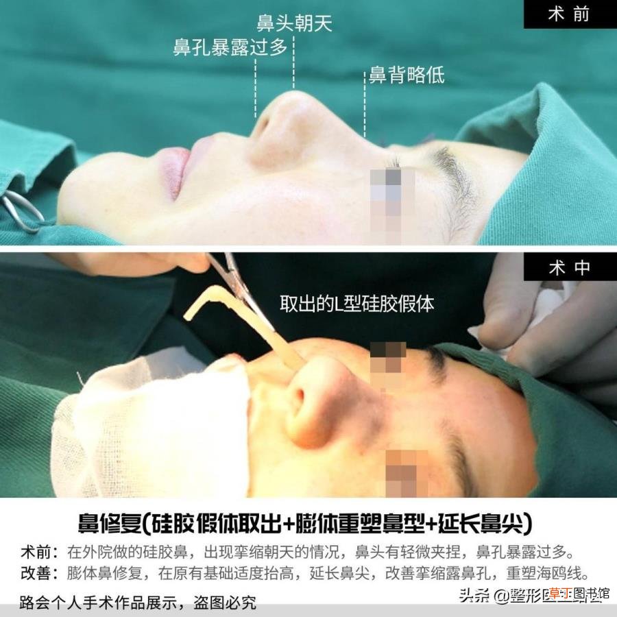 隆鼻拆线鼻子好宽好肿 隆鼻后多久拆线