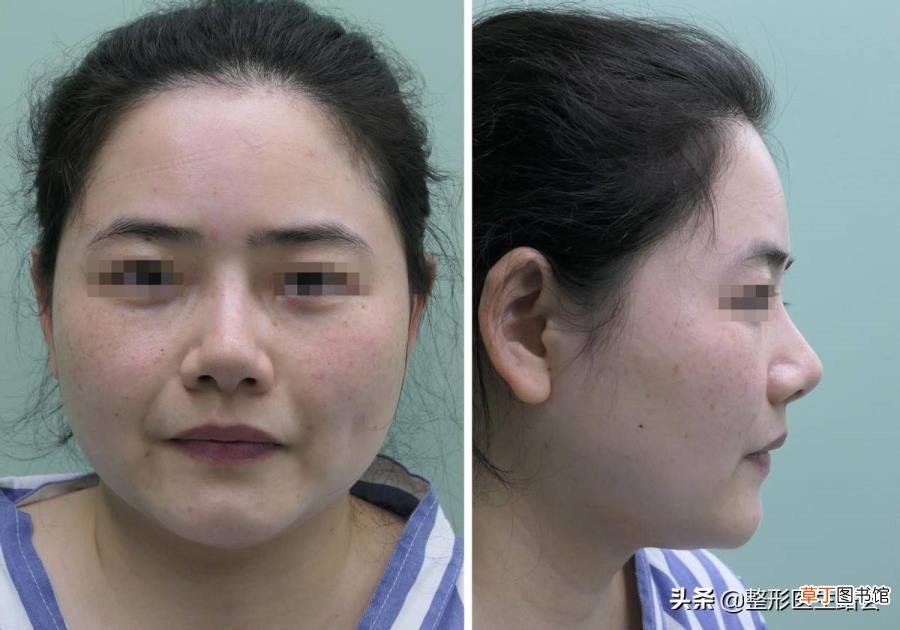 隆鼻拆线鼻子好宽好肿 隆鼻后多久拆线