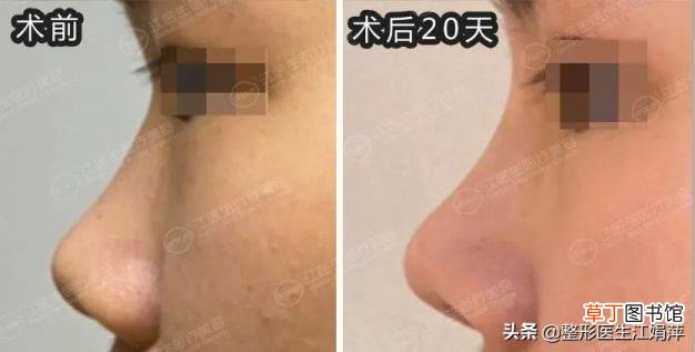 隆鼻后第几天开始消肿 做鼻子多久消肿
