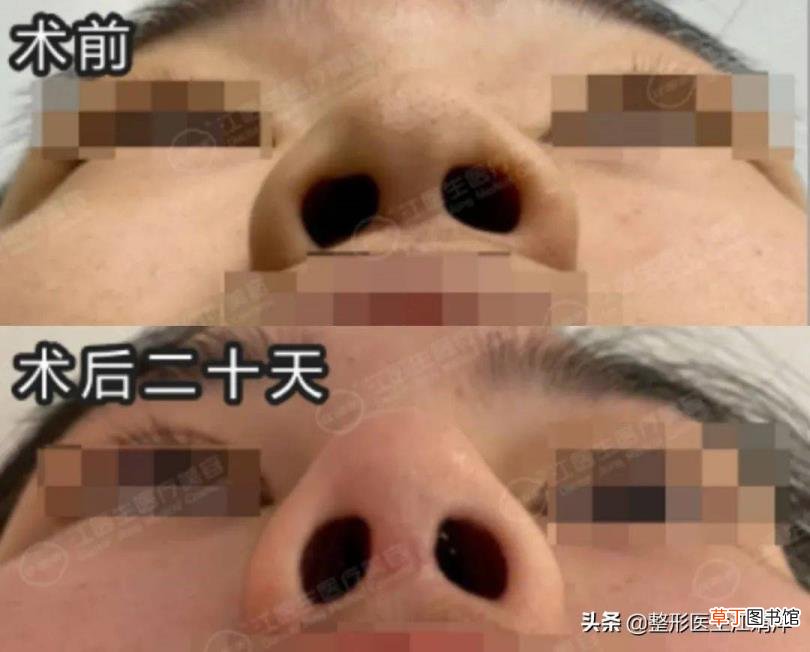 隆鼻后第几天开始消肿 做鼻子多久消肿